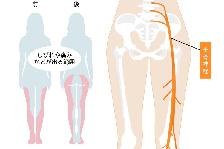 脊椎疾患画像02