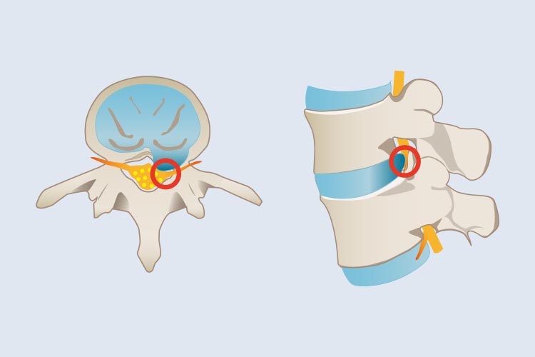 椎間板ヘルニア