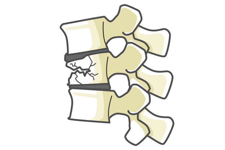 脊椎疾患画像05